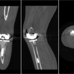 Fig. 4 CT scans of the left knee showing disruption of the cortical bone along the posteromedial proximal tibia immediately below the tibial component: (left) coronal cut, (middle) sagittal cut, and (right) axial cut.
