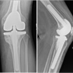 Fig. 7 Radiographs of the left knee at 3 months after excision and curettage of the tibial lesion with cementplasty, presenting a well-fixed total knee replacement and medial tibial cementation: (left) anteroposterior view, and (right) lateral view.
