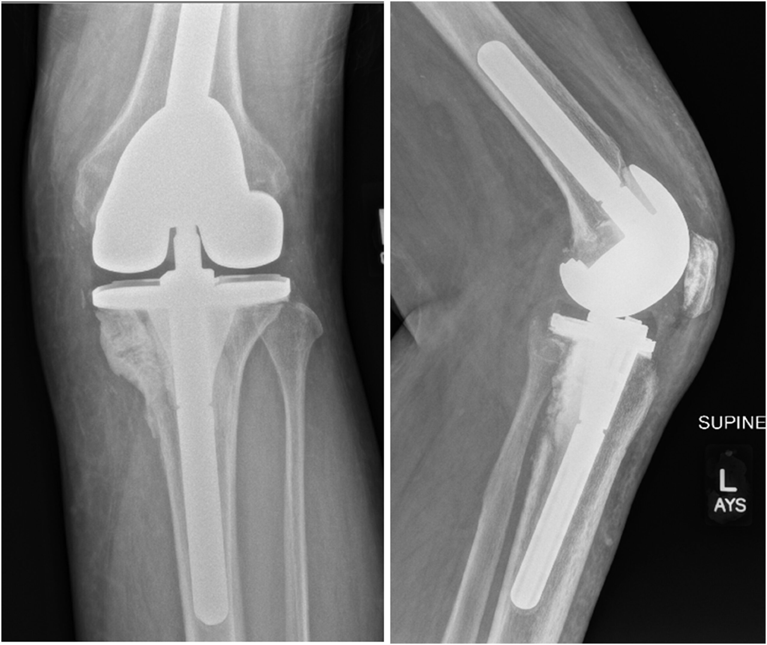 a-64-year-old-man-with-persistent-knee-pain-jbjs-image-quiz