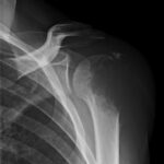 Fig. 1-B Lateral radiograph of the scapula depicting a lesion of the proximal left humeral head and metaphysis with suggestion of a soft-tissue component.
