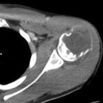 Fig. 2-A A CT scan of the proximal left humeral head, confirming a soft-tissue mass with destruction of the proximal left humeral metaphysis and lateral humeral head with extension into the glenohumeral joint space.
