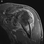 Fig. 2-B A post-gadolinium MRI scan of the proximal left humeral head, revealing a 5.0 × 4.9 × 5.5 cm lesion of the left humeral head with intra-articular involvement, circumferential biceps tendon sheath extension, and soft-tissue extension deep to the deltoid muscle.
