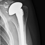 Fig. 4 A Grashey radiograph of the left shoulder at 2 months after reconstruction with an allograft prosthetic composite shoulder after hemiarthroplasty with an allograft capsular stabilization. The patient underwent en bloc resection with wide margins of the left proximal humerus with extra-articular shoulder excision including the glenoid and the shoulder capsule.
