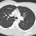 Fig. 6-A A chest CT scan illustrating diffuse pulmonary metastases (arrows) ranging in size from 5 to 11 mm in the longest dimension. Of note, we observed primarily centrally located pulmonary nodules on cross-sectional thoracic imaging.
