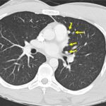 Fig. 6-B A chest CT scan illustrating diffuse pulmonary metastases (arrows) ranging in size from 5 to 11 mm in the longest dimension. Of note, we observed primarily centrally located pulmonary nodules on cross-sectional thoracic imaging.
