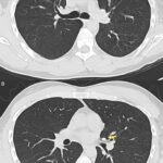 Fig. 8 Chest CT scans at the most recent follow-up demonstrating regression of pulmonary metastases (arrows). No new nodules were identified, and the stable nodules measured between 2 and 3 mm in the longest dimension.
