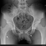 An 18-Year-Old Man with Persistent Hip Pain