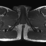 Fig. 3-A Axial, T1-weighted MRI scan of an expansile lesion of the lesser trochanter.

