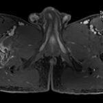 Fig. 3-B Post-gadolinium, fat-saturated, axial, T2-weighted MRI scan showing heterogeneous enhancement.
