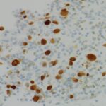 Fig. 6 Immunohistochemical analysis of a core needle biopsy specimen positive for S100 (magnification, ×400).
