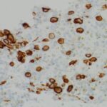 Fig. 7 Immunohistochemical analysis of a core needle biopsy specimen positive for CD1a (magnification, ×400).
