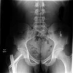 Fig. 8 Anterior-posterior radiograph of the pelvis, after the patient underwent intramedullary rod and screw fixation and completed a chemotherapy course, showing improvement in the lytic lesions of the left inferior pubic ramus and the right lesser trochanter.
