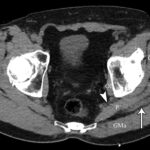 Fig. 5-A Axial CT image at the level of the piriformis muscle (P) showing a near muscle density mass (arrow) in the intermuscular plane between the gluteus maximus (GMa) and gluteus medius (GMe) muscles, abutting the lateral aspect of the sciatic nerve (arrowhead). GMi = gluteus minimus, and OI = obturator internus.

