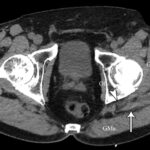 Fig. 5-B Axial CT image at the level of the ischial spine showing a near muscle density mass (arrow) in the intermuscular plane between the gluteus maximus (GMa) and gluteus medius (GMe) muscles, abutting the lateral aspect of the sciatic nerve (arrowhead). GMi = gluteus minimus, and OI = obturator internus.

