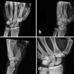 A 23-Year-Old Man with Increasing Wrist Pain