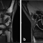Fig. 2 MRI scans of the left wrist with selected coronal T1-weighted (Fig. 2-A) and T2-weighted (Fig. 2-B) images showing the band of signal change.
