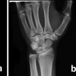 Fig. 3 MRI scans of the left wrist with selected coronal T1-weighted (Fig. 2-A) and T2-weighted (Fig. 2-B) images showing the band of signal change.
