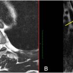 Fig. 1 MRI scans. Fig. 1-A Sagittal T2-weighted MRI scan without contrast of the thoracic spine showing abnormal bone marrow edema with superimposed sclerotic changes occupying the entire vertebral body. An inferior cortical-based lesion was noted, showing peripheral hyperintensity. Fig. 1-B Axial T2-weighted MRI scan without contrast of the thoracic spine. A lateral, cortical-based lesion showed peripheral hyperintensity.
