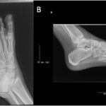 Fig. 1 Initial oblique radiograph (Fig. 1-A) and lateral radiograph (Fig. 1-B) of the left foot demonstrating a lytic lesion within the cuboid.
