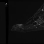 Fig. 3 Axial (Fig. 3-A) and sagittal (Fig. 3-B) T2-weighted MRI scans and coronal T1-weighted postcontrast MRI scan (Fig. 3-C) of the left foot at 6 months after the initial presentation demonstrating an enlargement of the lesion in the cuboid.
