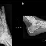 Fig. 4 Oblique (Fig. 4-A) and lateral (Fig. 4-B) radiographs of the left foot at 6 months after the initial presentation demonstrating an enlargement of the lesion within the cuboid.
