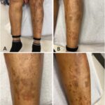 Fig. 1 The patient had brown plaques and round, erythematous plaques with overlying scales on the left leg. Fig. 1-A Photograph of the plaques and overlying scales. Figs. 1-B, 1-C, and 1-D Close-up photographs of the same lesions.
