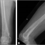 A 59-Year-Old Man with Long-Term Knee Pain