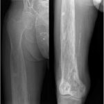 Fig. 10 Anterior-posterior right femoral radiographs, 10 months after biopsy, illustrating the stable extent.
