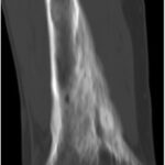 Fig. 3 Coronal right femoral CT scan from 2012 showing cortical bone loss and periosteal new bone formation corresponding to the signal abnormality on MRI scan and the progression of Paget disease.
