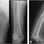 Fig. 5 Anterior-posterior (Fig. 5-A) and lateral (Fig. 5-B) right femoral radiographs showing considerable proximal progression.
