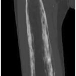 Fig. 6 Coronal right femoral CT scan showing considerable progressive proximal extension and cortical expansion with aggressive appearance.
