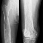 Fig. 9 Anterior-posterior right femoral radiographs, 4 months after biopsy, showing even further proximal progression of the affected bone.
