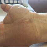 A 57-Year-Old Woman with Increasing Wrist Pain