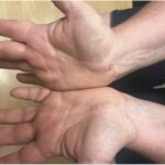 Fig. 2 Palmar aspects of bilateral hands displaying subcutaneous nodules along previously well-healed scars.
