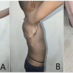 Fig. 4 Clinical photographs showing multiple swellings over the dorsal region and scapular area (Figs. 4-A and 4-B) and hallux valgus and brachydactyly deformity (Fig. 4-C).
