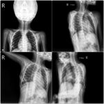 Fig. 5 Anteroposterior (left) and Y-view (right) radiographs showing multiple ossified lesions involving the dorsal and scalp area suggesting heterotopic ossification.
