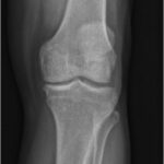 Fig. 1-A A preoperative standing anteroposterior radiograph of the left knee.
