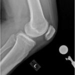 Fig. 1-B Preoperative standing lateral radiograph of the left knee.
