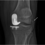 Fig. 3-A Standing anteroposterior radiograph showing a mineralized fragment (arrow).
