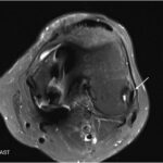 Fig. 3-C Axial MRI section showing an adjacent tendon (arrow).
