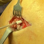 Fig. 4-D Photograph of the open repair of the avulsed popliteal tendon showing the insertion of a 5.5-mm biocomposite suture anchor (Corkscrew, Arthrex).
