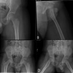 A 12-Year-Old Boy with Hip Pain Following a Fall