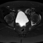 Fig. 2 Axial MRI scan with contrast of the left hip exhibited a robust, edema-like signal and postcontrast enhancement of the left ischium and left hip joint effusion concerning for osteomyelitis or septic arthritis. Furthermore, areas of low-signal intensity and nonenhancement were seen along the left acetabulum concerning for osteonecrosis. The MRI scan did not demonstrate a labral or capsule tear.
