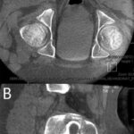 Fig. 3 Axial CT slice (Fig 3-A) and sagittal CT slice (Fig 3-B) made during a CT-guided biopsy.
