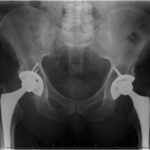 A 77-Year-Old Man with Long-Term Hip Pain