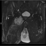 Fig. 4 Coronal MRI T2-weighted short tau inversion recovery slice showing the soft-tissue mass around the right total hip replacement. The mass has a thickened pseudocapsule and surrounding edema compressing the adductor muscles.
