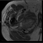 Fig. 5 Transverse MRI T1-weighted slice showing the solid lesion around the right total hip replacement. The lesion has surrounding edema and is compressing the adductor muscles and neurovascular bundle.

