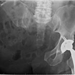 Fig. 6 Anteroposterior radiograph after the right external hemipelvectomy.
