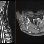 Fig. 1 (Left) Sagittal T2-weighted MRI scan showing the lesion originating from the anterior facet of the C2 lamina. (Right) Axial T2-weighted MRI scan showing the lesion occupying part of the medullary canal.
