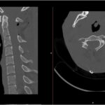 Fig. 3 Postoperative CT scans showing the sagittal (left) and axial (right) planes after a right hemilaminectomy with a complete lesion excision.
